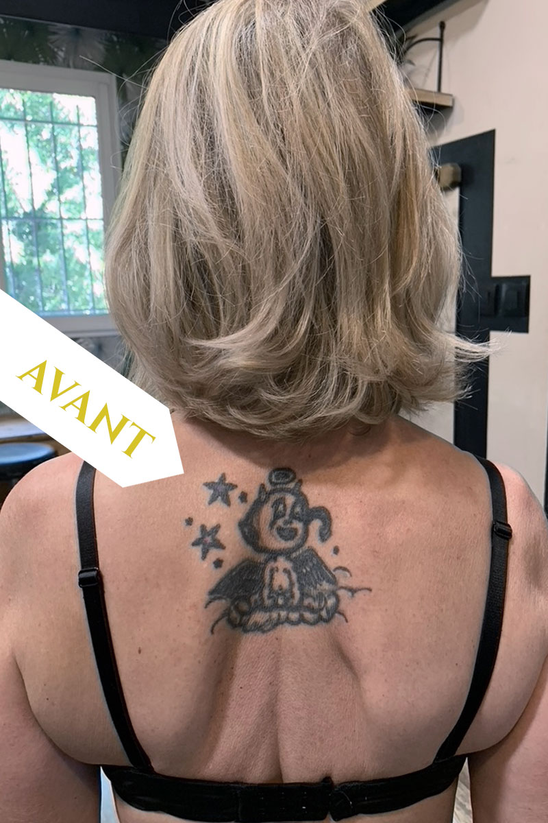 Avant recouvrement tatouage